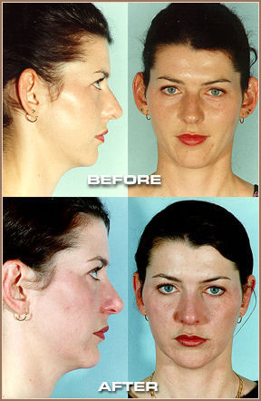 Before and After