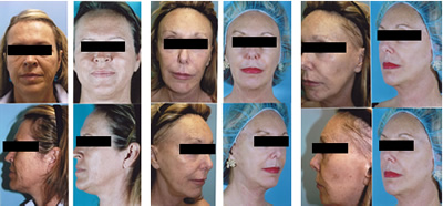 Fractionated Laser Skin Resurfacing